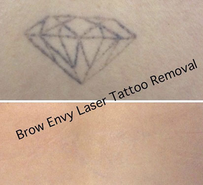 Laser Tattoo Removal at Brow Envy