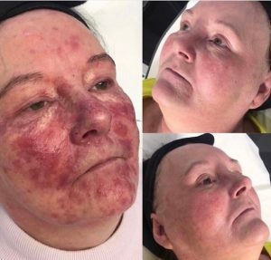 Rosacea Treatments Plymouth