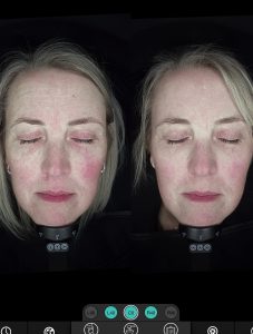 observ skin consultation